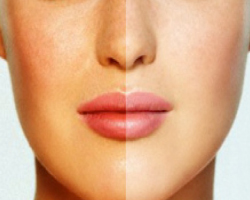 ESTIMULACIÓN DE COLÁGENO IPL Diana