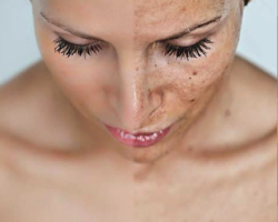 LESIONES PIGMENTADAS IPL Diana