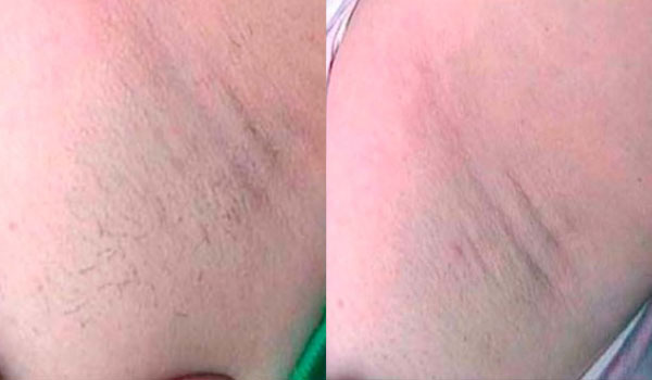 IPL Diana caso depilación